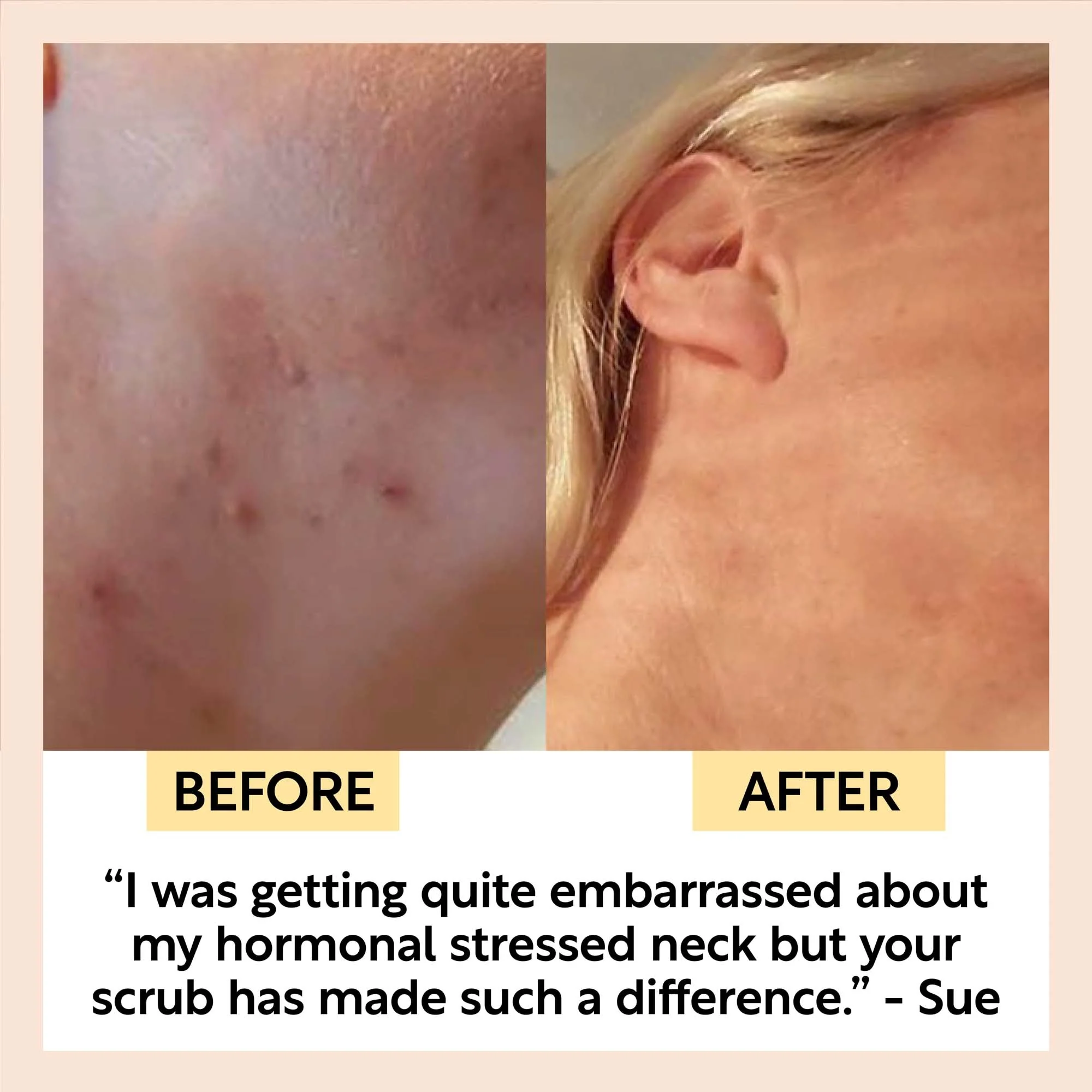 UpCircle The Acne-Prone Bundle - Image 10