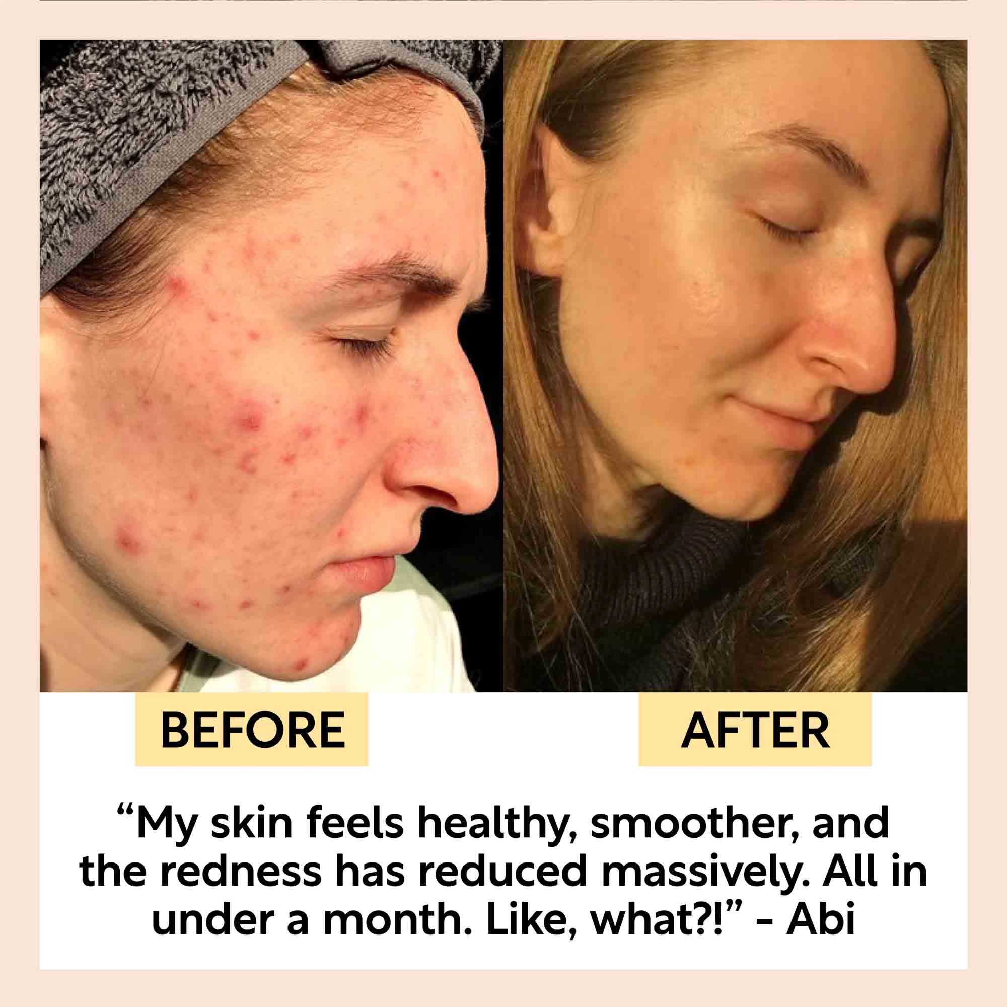 UpCircle The Acne-Prone Bundle - Image 9